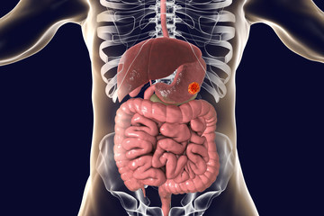 Stomach cancer, 3D illustration showing human digestive systemy anatomy and tumor inside stomach - obrazy, fototapety, plakaty