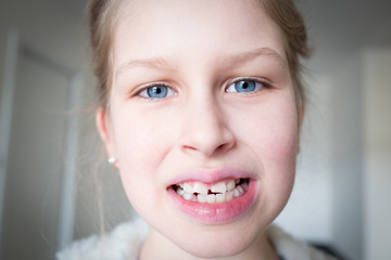 Dental problem, permanent teeth injury