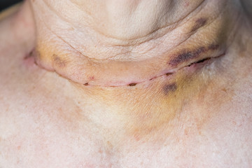 Naklejka premium Surgical suture after operation on the thyroid gland.