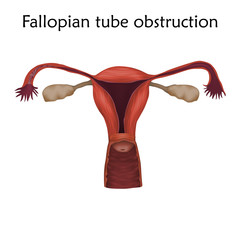 Fallopian tube obstruction. Human realistic uterus. Anatomy illustration. Colored image, white background. Gynecological diseases.