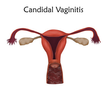 Candidal Vaginitis. Human realistic uterus. Anatomy illustration. Colored image, white background. Gynecological diseases.