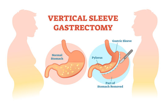 Vertical Sleeve Gastrectomy medical vector illustration diagram with stomach surgical cut.