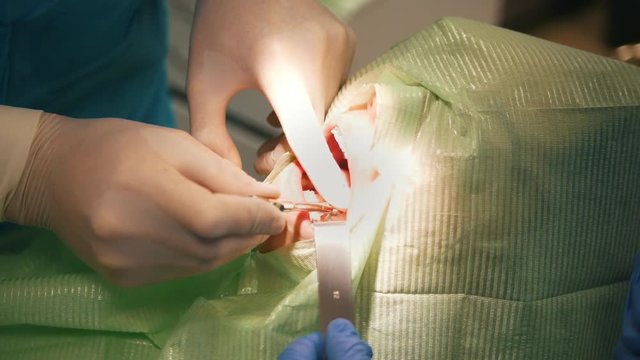 Dentist using surgical pliers to remove a decaying tooth in stomatology room