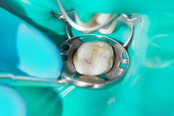 close-up of a human rotten carious tooth at the treatment stage in a dental clinic