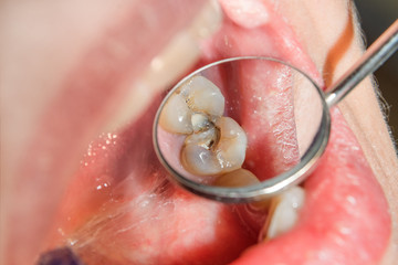 Fototapeta premium Dental treatment in dental clinic. Rotten carious tooth macro. Treatment endodontic canals