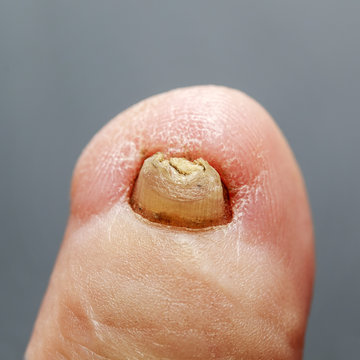 plain toe with a nasty terrible nail affected by the fungus