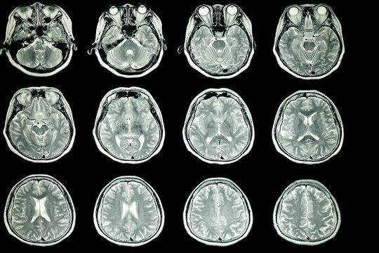 MRI scan of patient brain