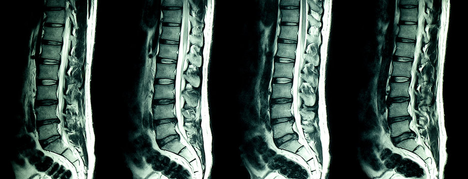 MRI scan of lumbar spines of a patient with chronic back pain.
