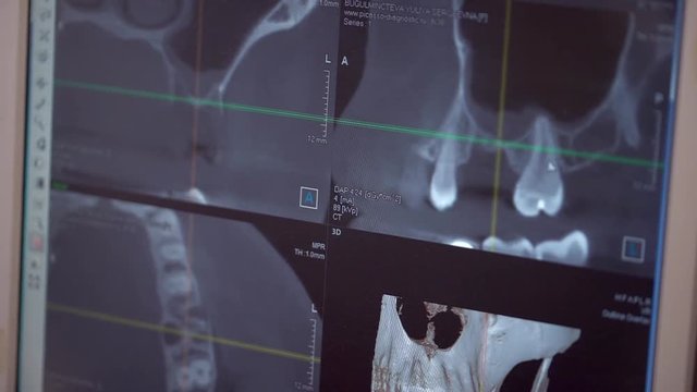 dental assistent discussing with dentist about the tooth's problem on x-ray shot. slow-motion. close-up. Dental X ray with bad teeth. slow-motion. dentist examining x-ray report on computer in clinic