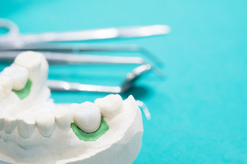 Fototapeta na wymiar Implan model tooth support fix bridge implan and crown.