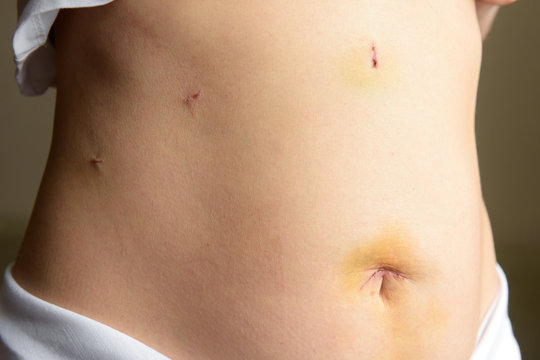 Abdomen with medical stitches after surgery by laparoscopy