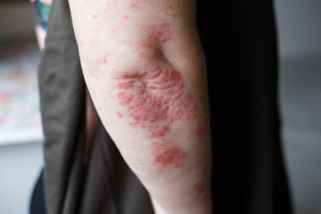 Psoriasis skin. Psoriasis is an autoimmune disease that affects the skin cause skin inflammation red and scaly. Eczema skin