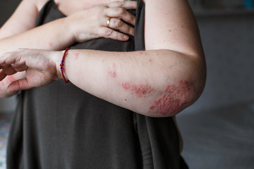 Psoriasis skin. Psoriasis is an autoimmune disease that affects the skin cause skin inflammation red and scaly. Eczema skin