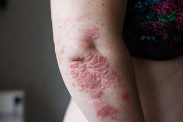 Psoriasis skin. Psoriasis is an autoimmune disease that affects the skin cause skin inflammation red and scaly. Eczema skin