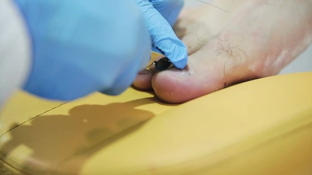 hand physician Podiatry titanium bonded thread to the nail of male patient in the beauty salon, close-up