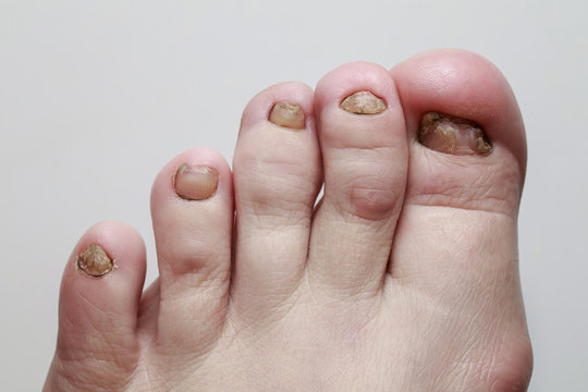 Foot With Nagatani Struck By A Terrible And Nasty Disease Fungus Closeup