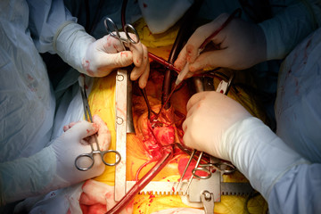 surgeons and anesthetist operating during cardiac operation of CABG