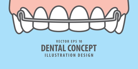 Banner Upper Hawley retainer illustration vector on blue background. Dental concept. © paladjai