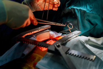 surgical instruments for open heart surgery