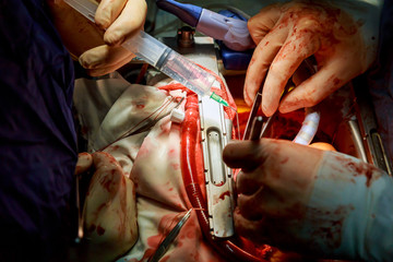 Open heart surgery with different surgical tools and tubes connected to a heart