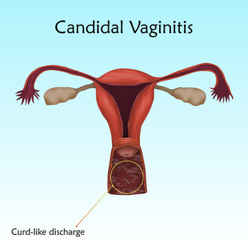 Candidal Vaginitis. Human realistic uterus. Anatomy illustration with specification. Colored image, blue background. Gynecological diseases.