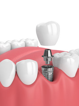 3d render of jaw with teeth and dental premolar implant over white background