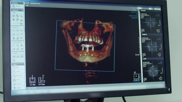3D view of maxillary and mandible