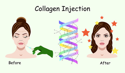 Vector illustration with collagen injection process on the white background