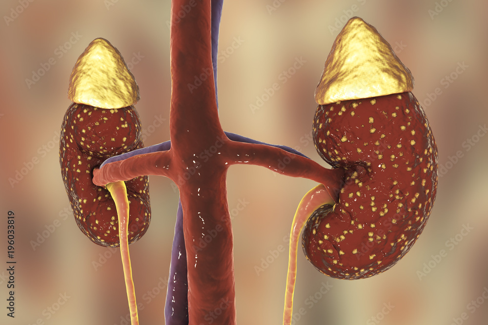 Poster Pyelonephritis, medical concept, 3D illustration showing presence of purulent blisters in kidney tissue