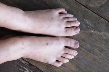 Dirty children finger nails. Dirty finger nails.