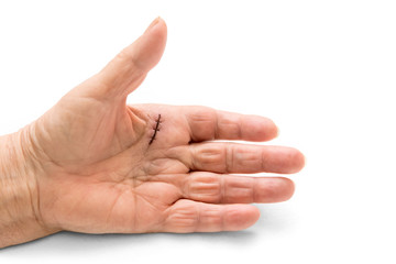 Hand mit Naht, Erkrankung Morbus Dupuytren oder Schnappfinger, schnellender Finger