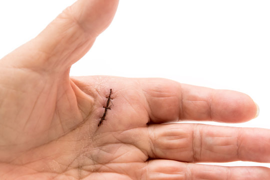Nahaufnahme Naht an der Hand, Dupuytren Kontraktur oder krummer Finger
