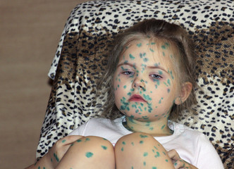 Portrait of cute little girl 3-4-5 years old with sad eyes, with  chickenpox, pimples anointed with green medicinal preparations, colored spots on the body.