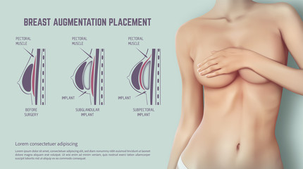 Diagram about method of insertion for breast implant. Plastic surgery of breast implants illustration. - obrazy, fototapety, plakaty
