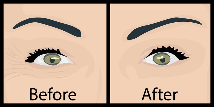 Wrinkles and fine lines under eyes to remove. Before and After. Eyes lifting