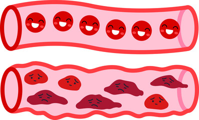 Healthy blood vessel and Unhealthy blood vessel 2