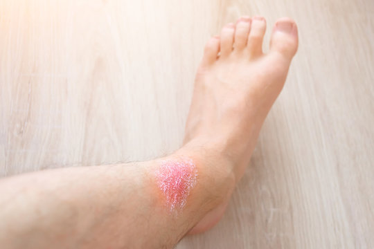 Skin irritation of feet, applied cream on the skin from irritation.