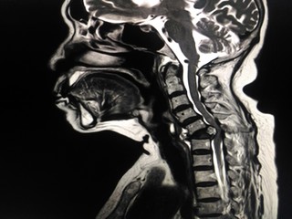 MRI.Cervical spine a human showing mass or tumor in bone neck