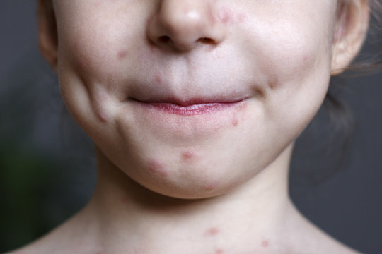 The baby's body, covered with red stains from chicken pox