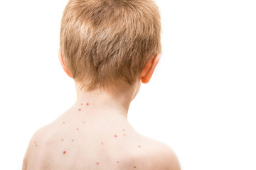 child with varicella