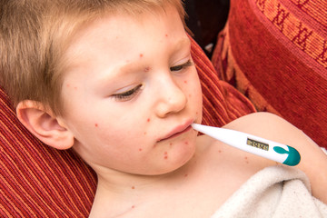 child with varicella that measures fever