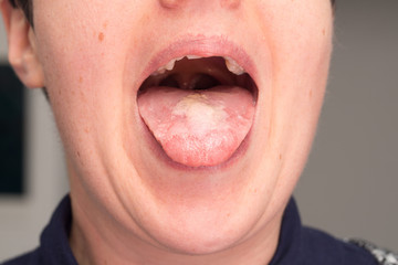 Candida albicans white infection on woman tongue