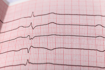 Analysis and Interpretation of the Electrocardiogram
