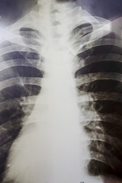 X-ray of a human chest or lungs radiography shot.
