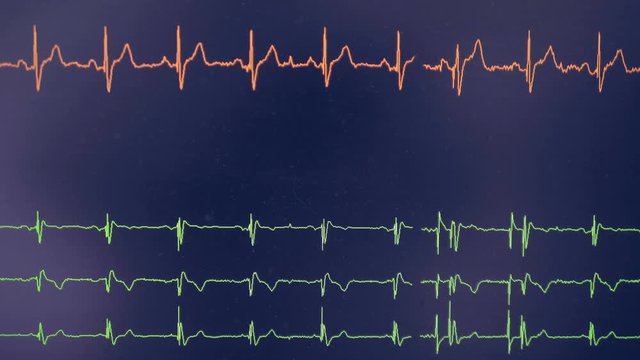 Real cardiogram. Cardiograph oscilloscope show heart beat rate on a screen.