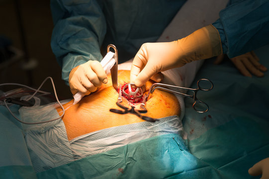 HIP PROSTHESIS SURGERY