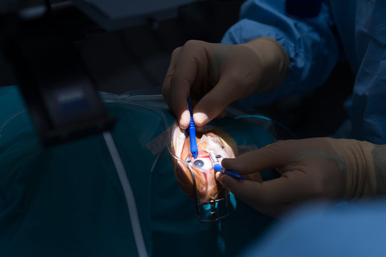 RETINAL DETACHMENT SURGERY