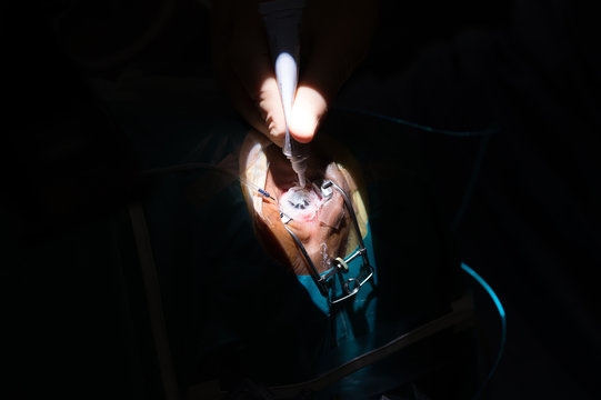 RETINAL DETACHMENT SURGERY