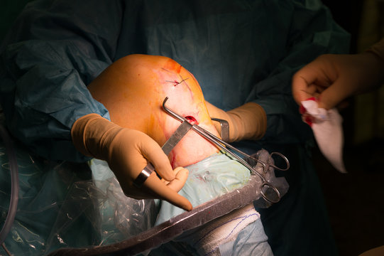 LIGAMENT SURGERY