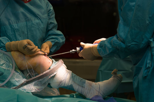 LIGAMENT SURGERY